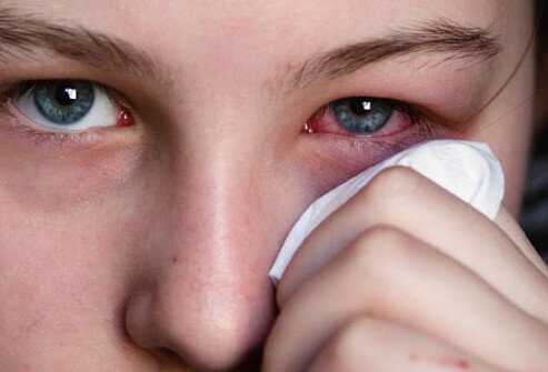 pink-eye-conjunctivitis-s1-photo-of-woman-holding-tissue-to-reddened-eye